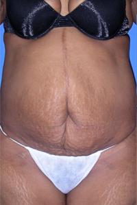 Tummy Tuck Patient Photo - Cosmetic Surgery Center