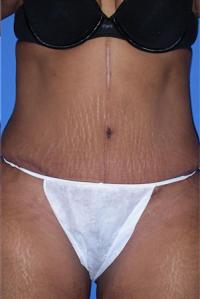 Tummy Tuck After