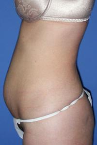 Tummy Tuck