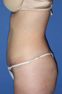 Tummy Tuck