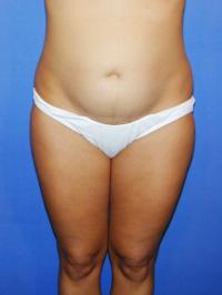 liposuction before