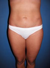 liposuction after