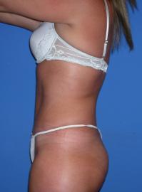 tummy tuck after