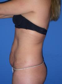 tummy tuck before