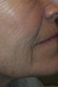 Laser Resurfacing Before