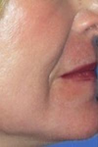 Laser Resurfacing After