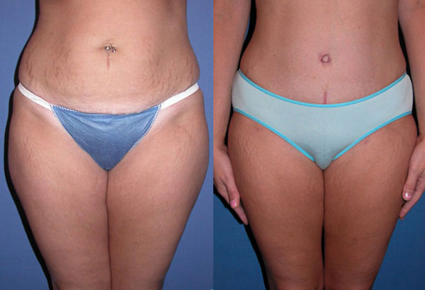 Abdominal Binder Post Surgery Compression Wrap – Torso Liposuction