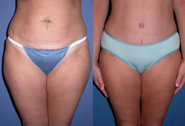 One day after tummy tuck surgery with compression garnent and