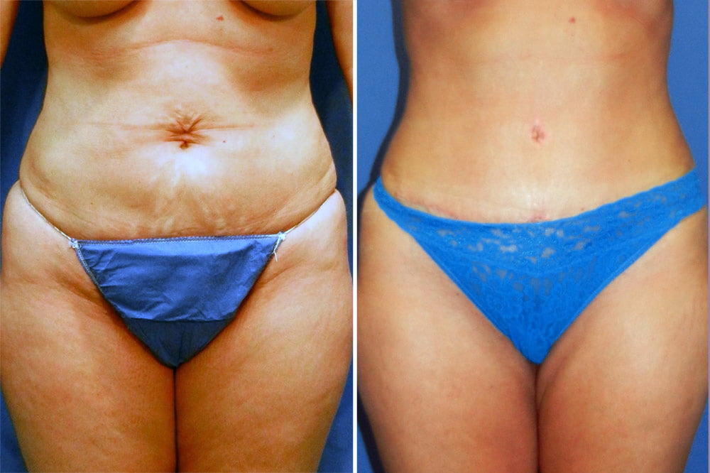 Tummy Tuck Case # 200