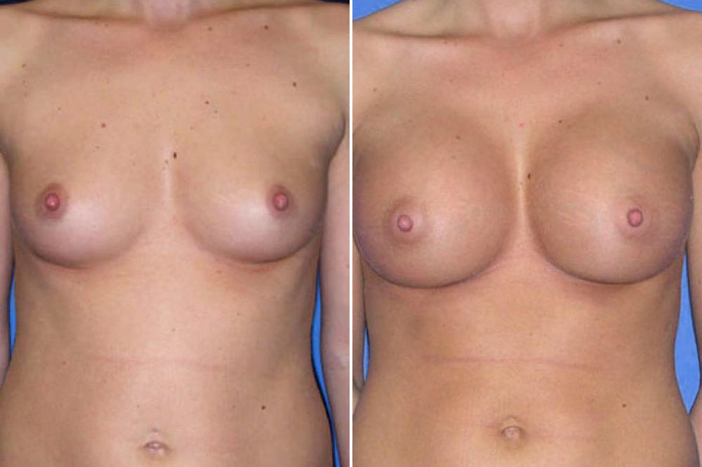 Breast Augmentation Case # 108