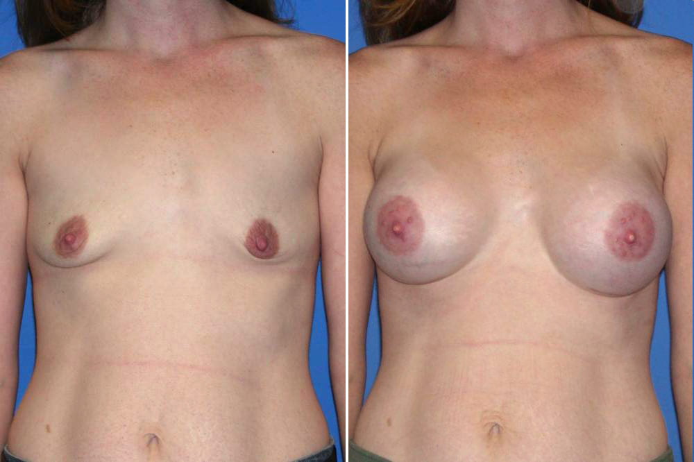 Breast Augmentation Case # 156