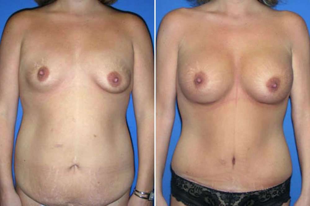 Breast Augmentation Case # 110