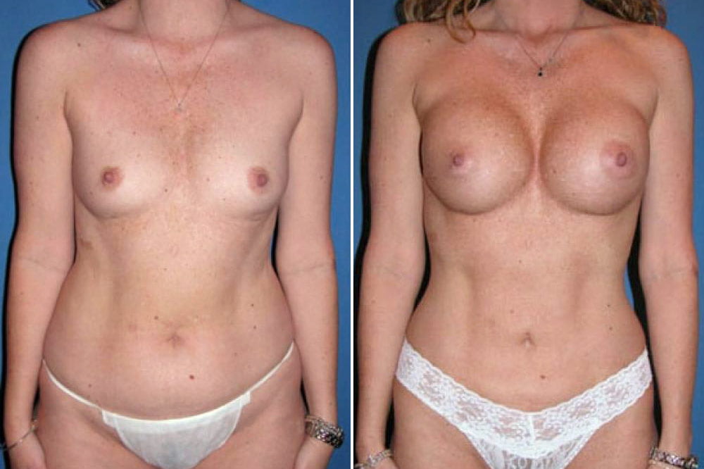 Breast Augmentation Case # 111