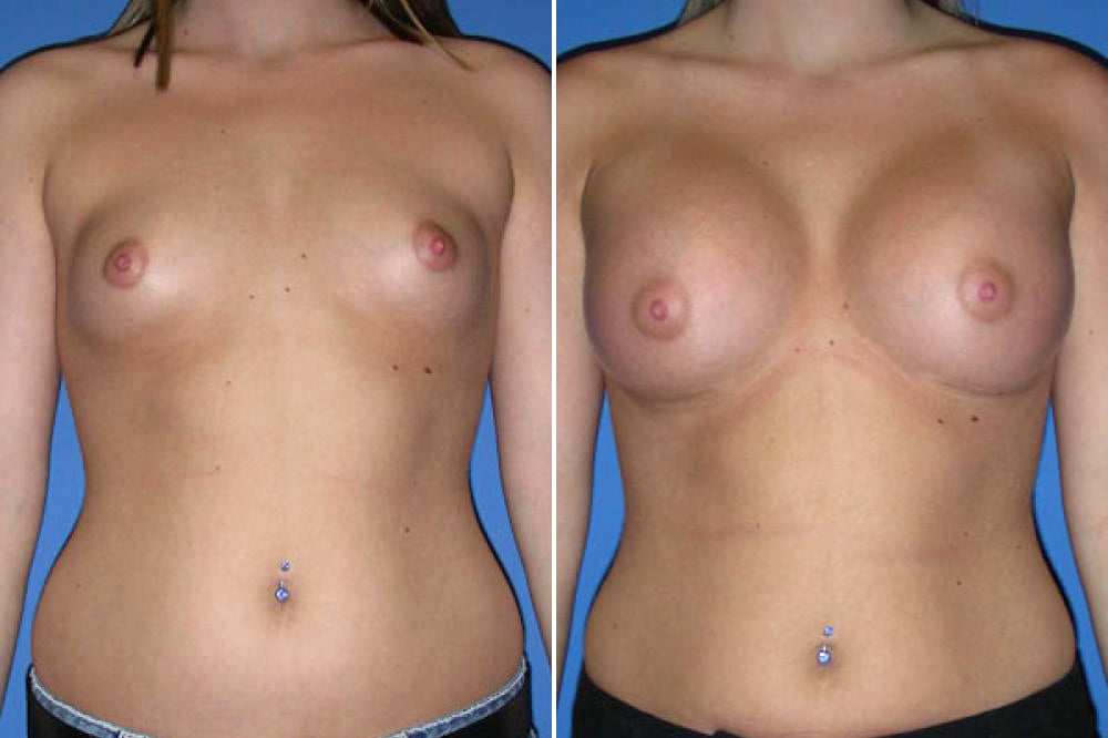 Breast Augmentation Case # 113