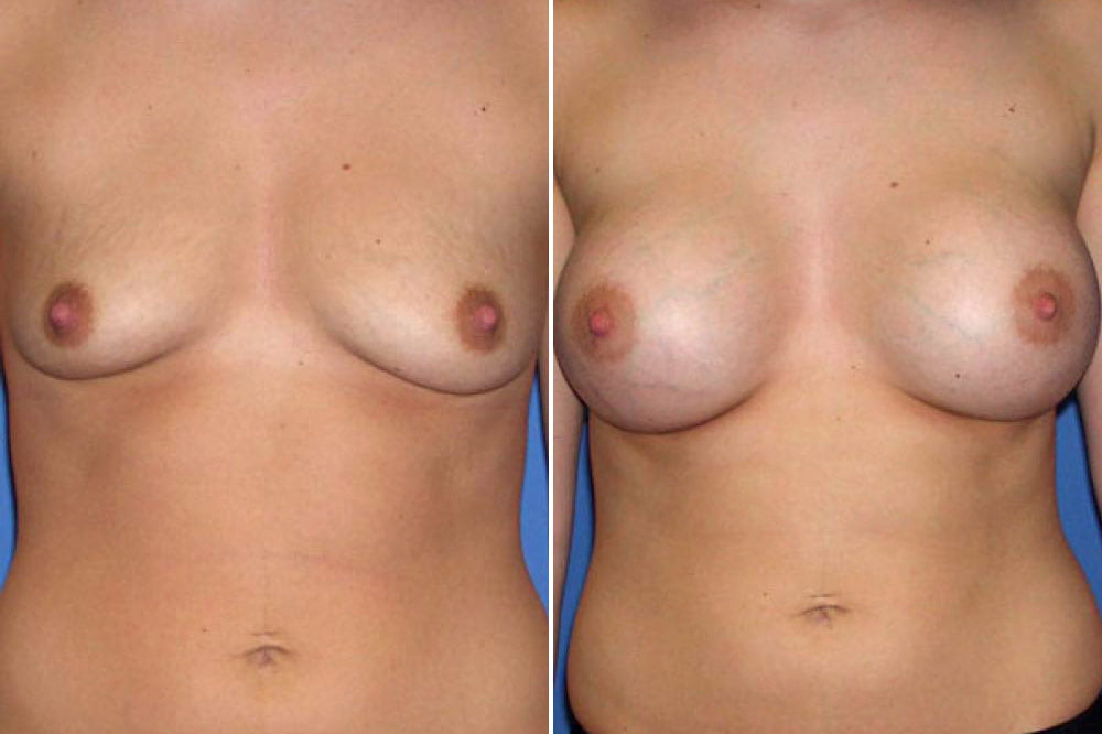 Breast Augmentation Case # 114