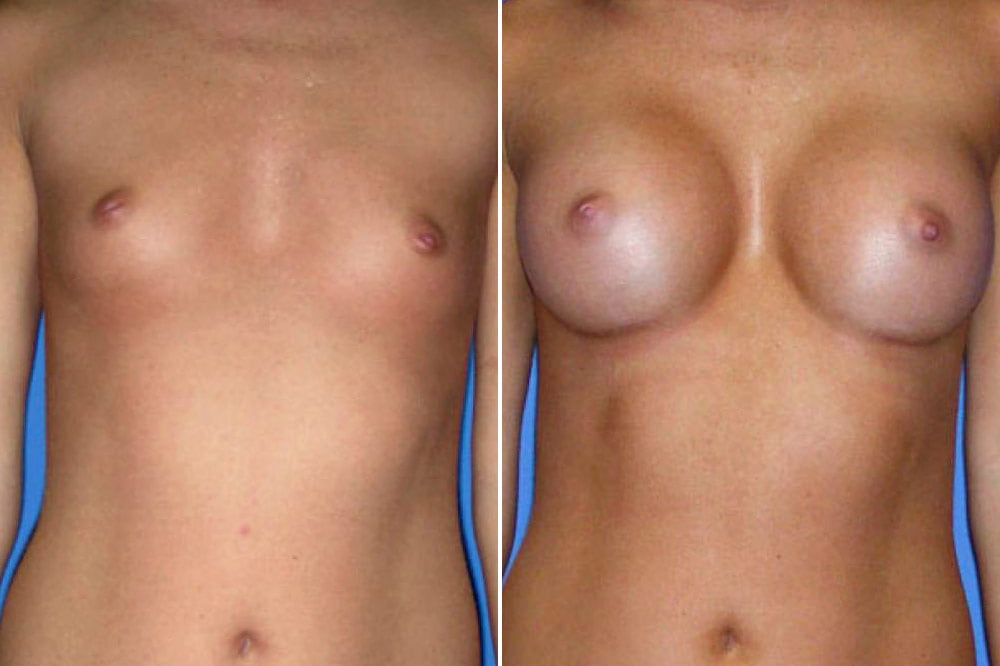 Breast Augmentation Case # 116