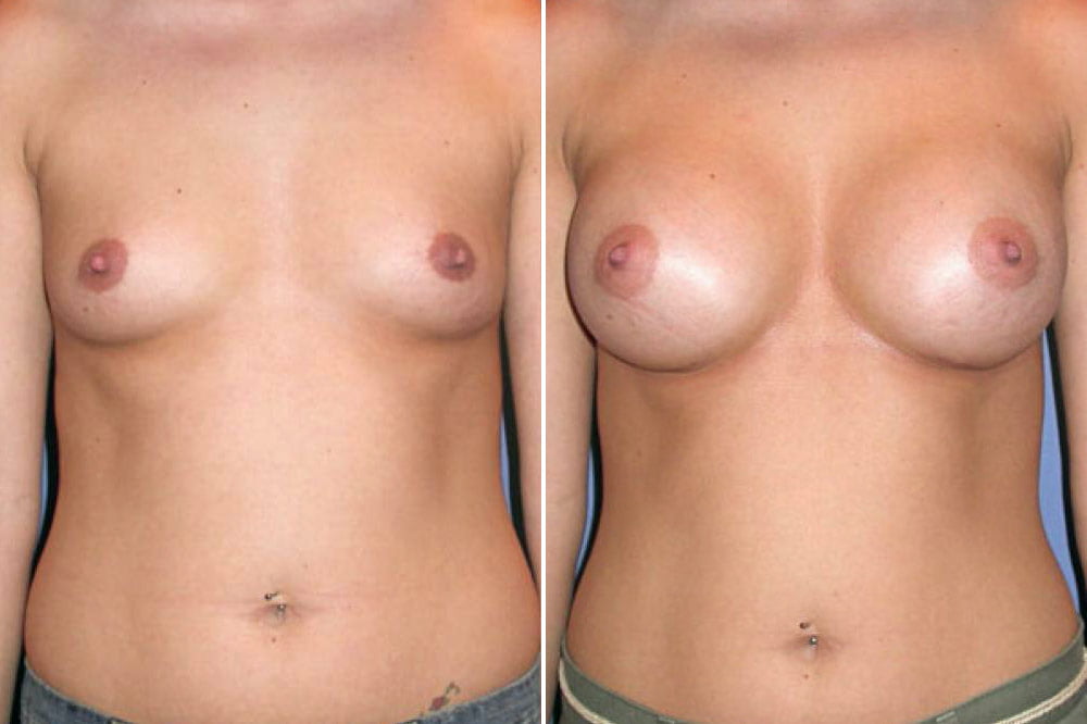 Breast Augmentation Case # 117