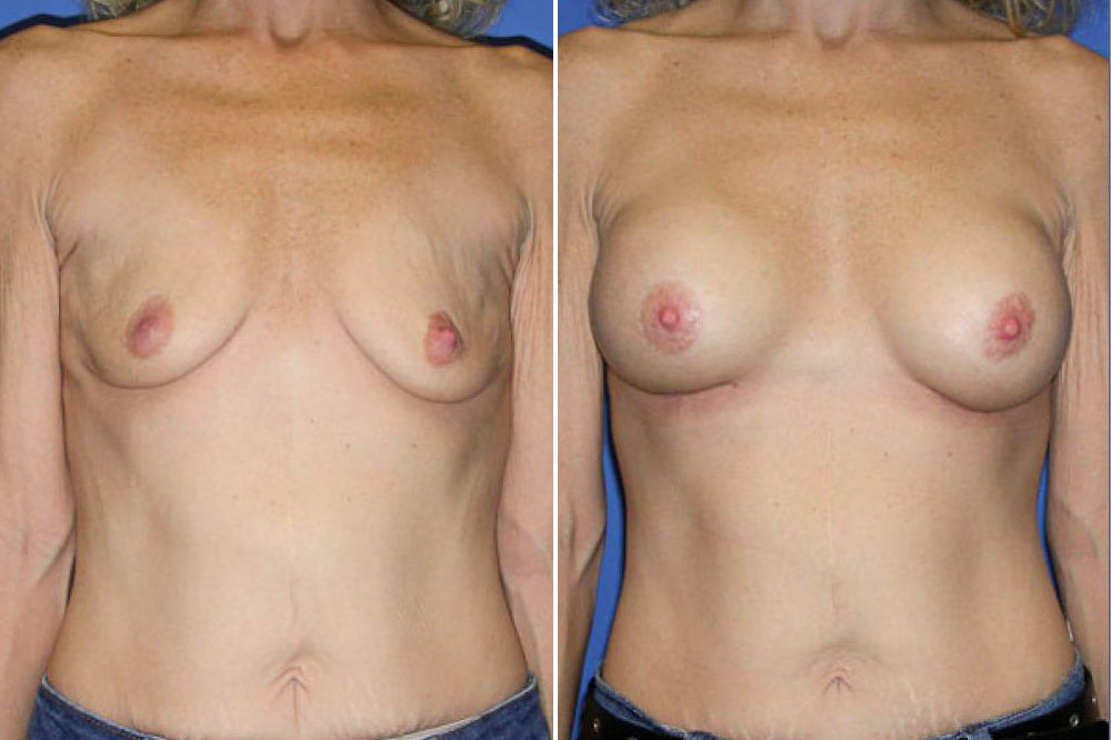 Breast Augmentation Case # 118