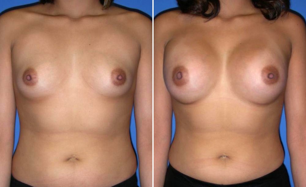 Breast Augmentation Case # 150