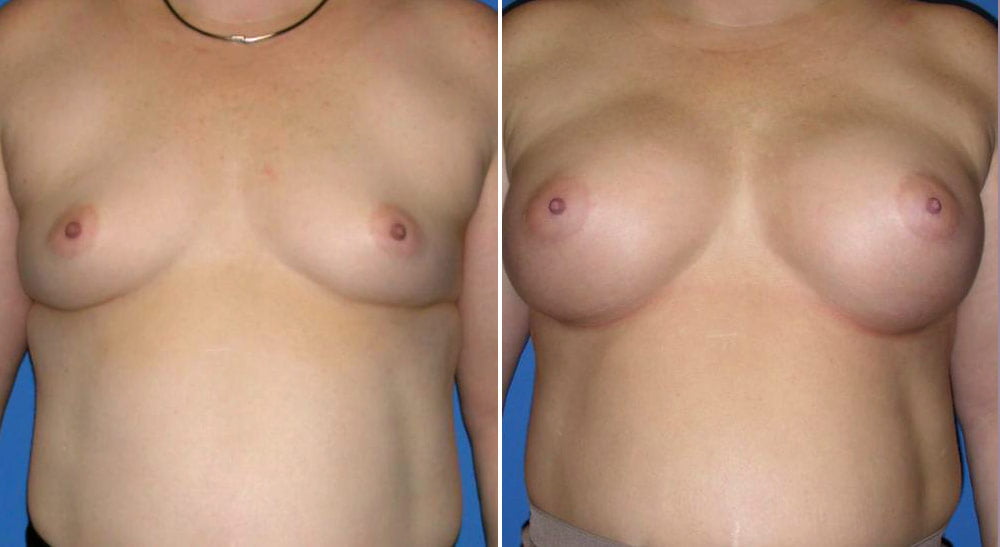 Breast Augmentation Case # 143