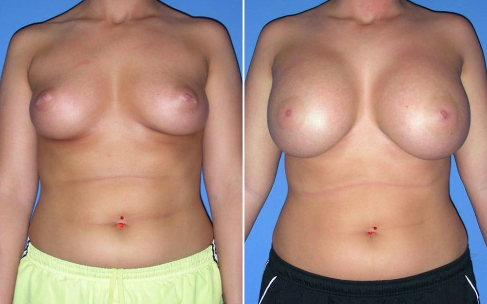 Breast Augmentation Case # 145