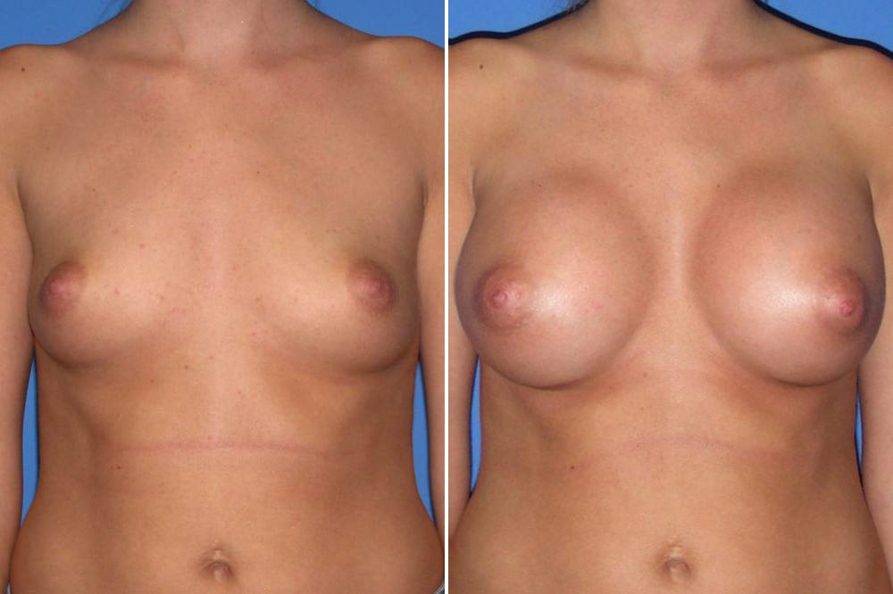 Breast Augmentation Case # 146