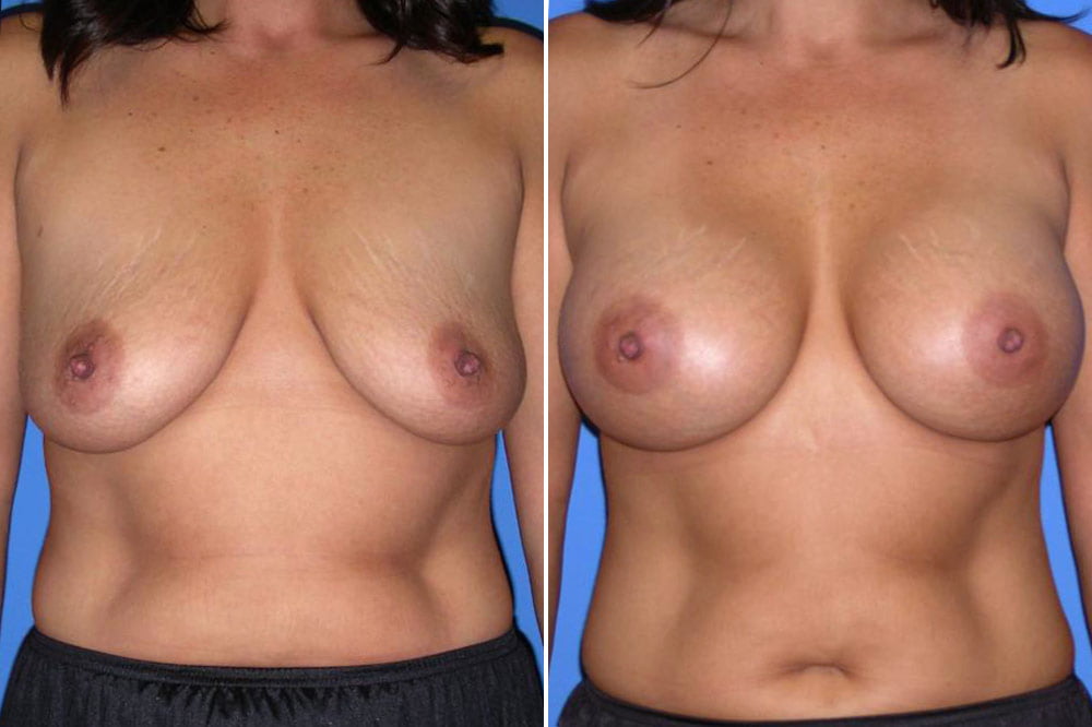 Breast Augmentation Case # 148