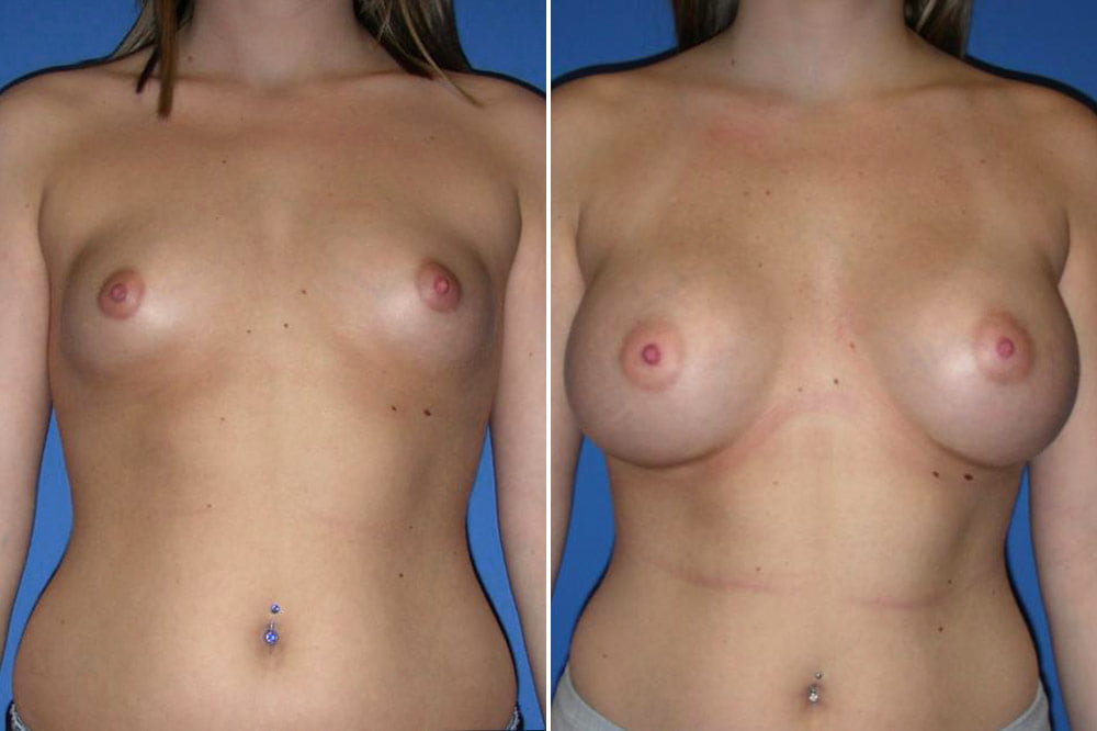 Breast Augmentation Case # 149