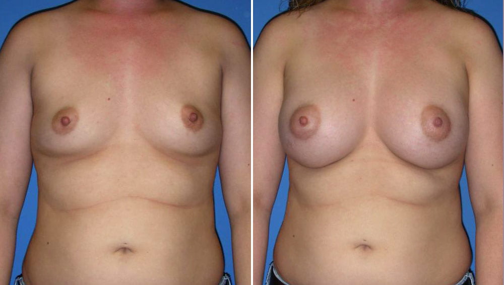 Breast Augmentation Case # 151