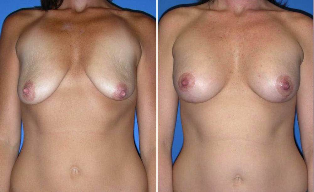 Breast Augmentation Case # 152