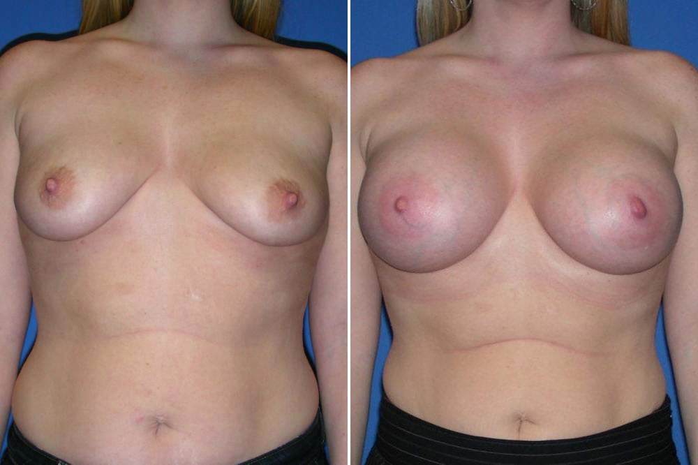 Breast Augmentation Case # 157