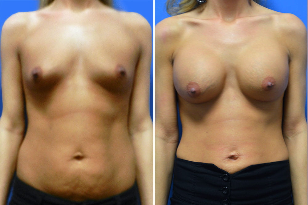 Breast Augmentation Case # 201