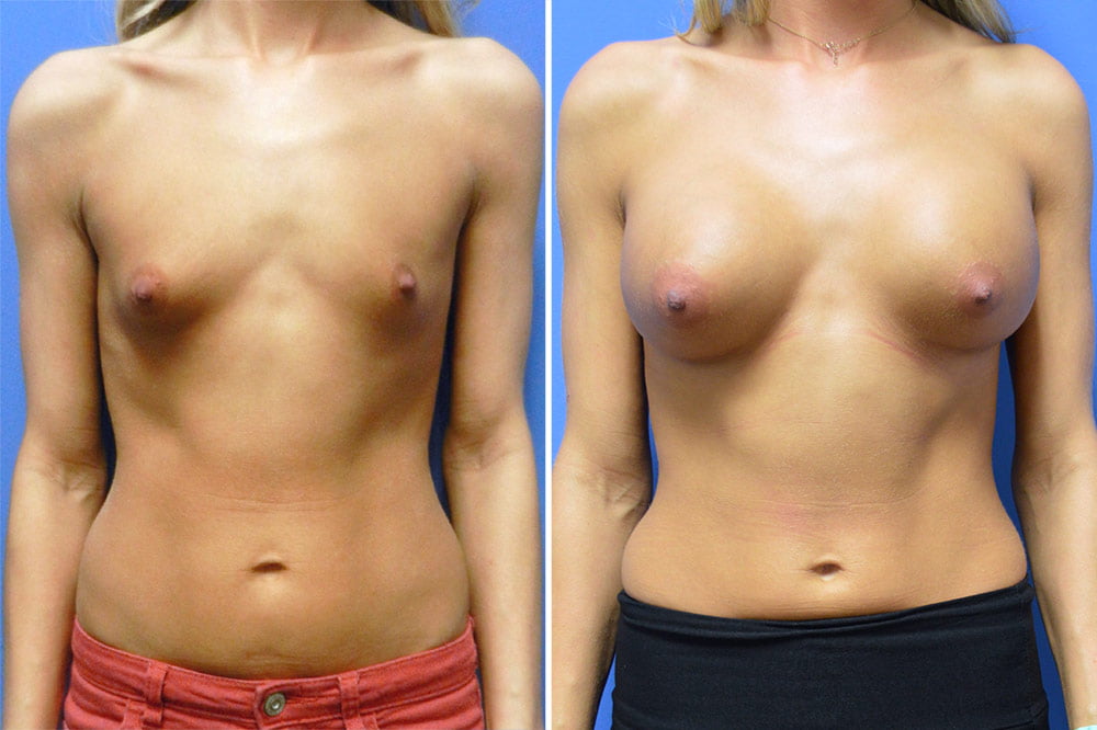 Breast Augmentation Case # 203