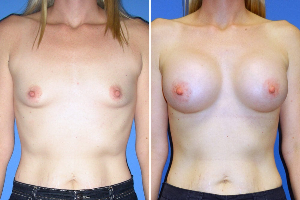 Breast Augmentation Case # 204