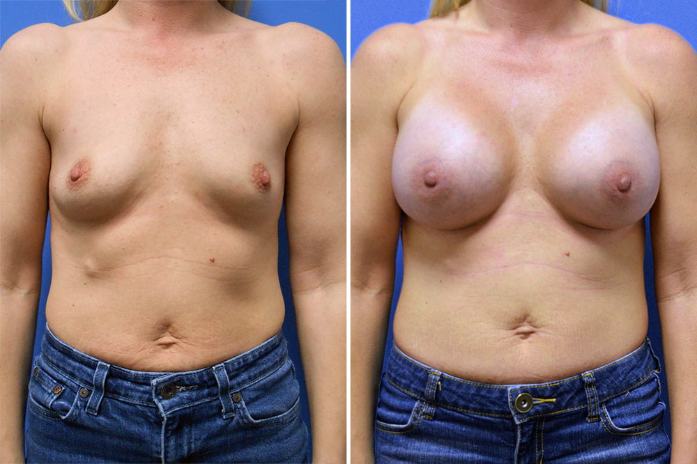 Breast Augmentation Case # 207