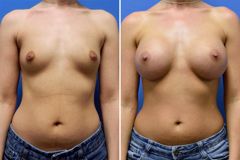 Breast Augmentation Case # 208