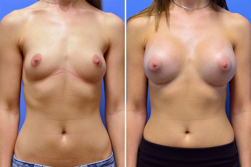 Breast Augmentation Case # 210