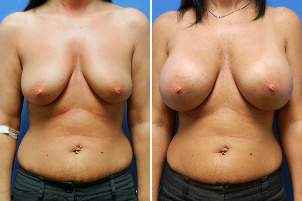 Breast Augmentation Case # 212