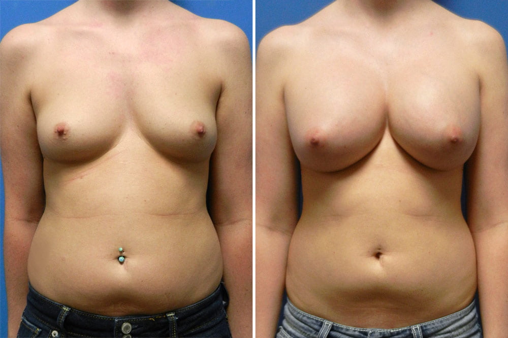 Breast Augmentation Case # 213