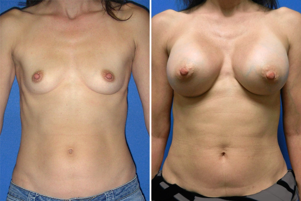 Breast Augmentation Case # 215