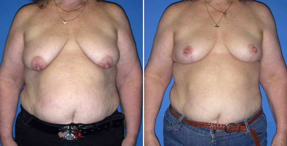 Breast Lift Case # 142