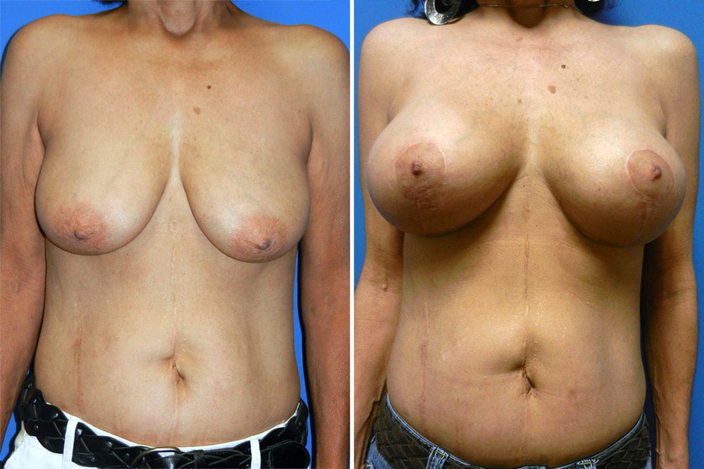 Breast Lift with Augmentation Case # 200