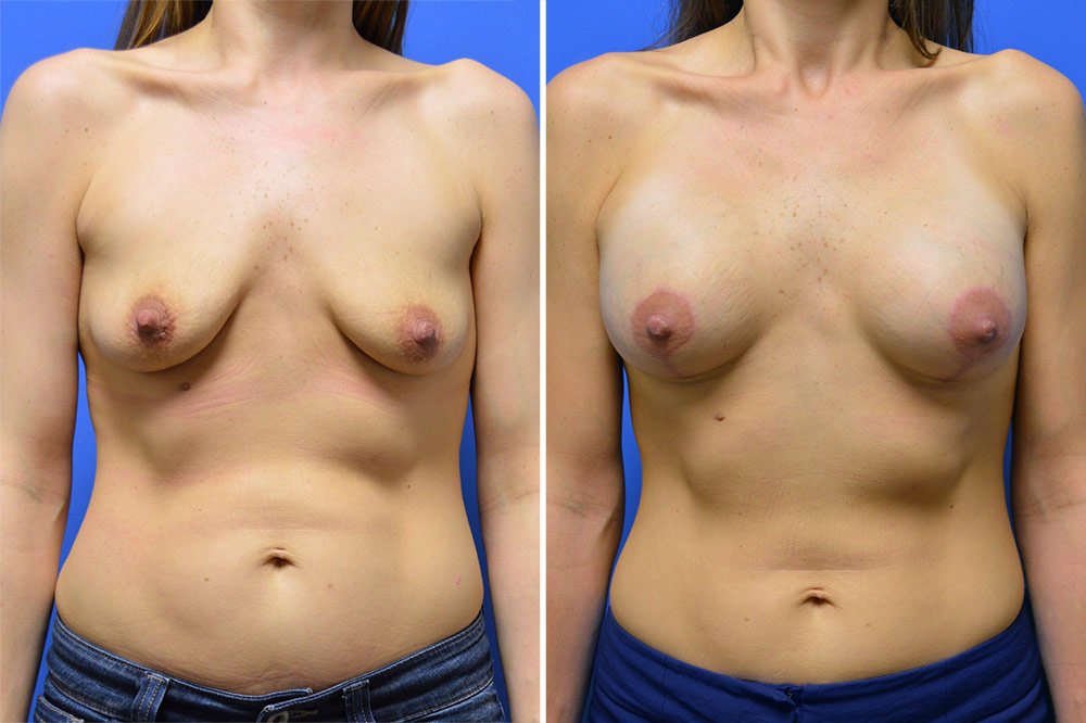 Breast Lift with Augmentation Case # 201