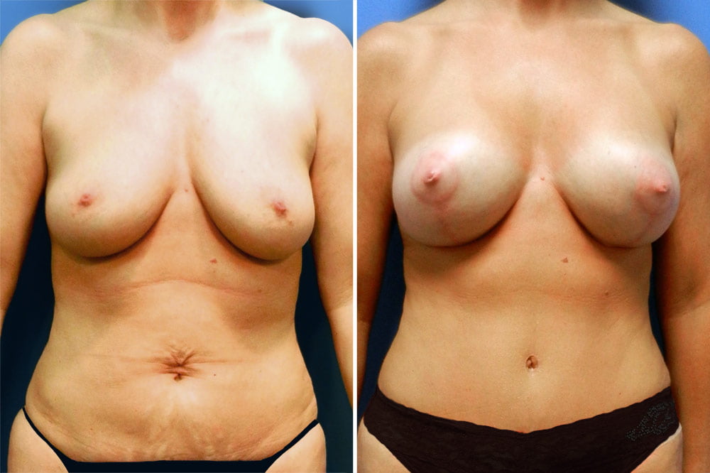 Breast Lift with Augmentation Case # 203