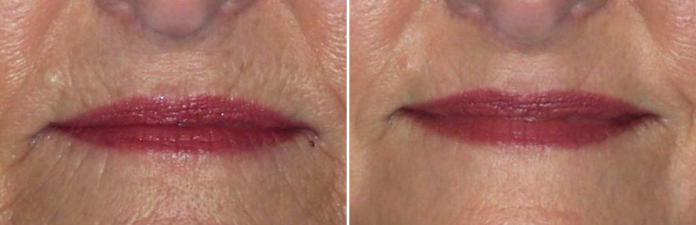 Laser Resurfacing Case # 173