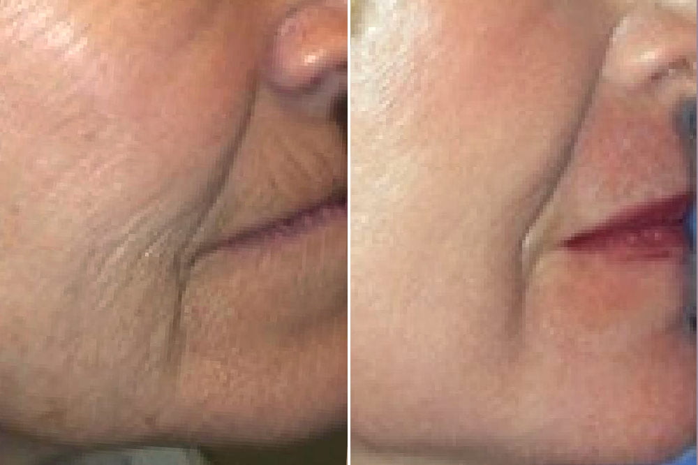 Laser Resurfacing Case # 174