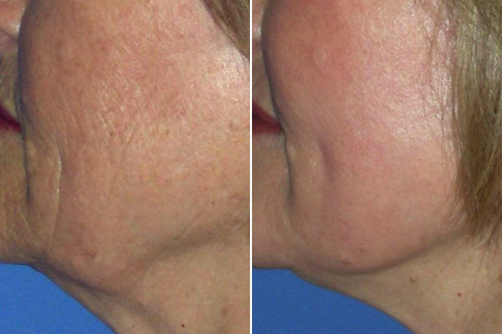 Laser Resurfacing Case # 175