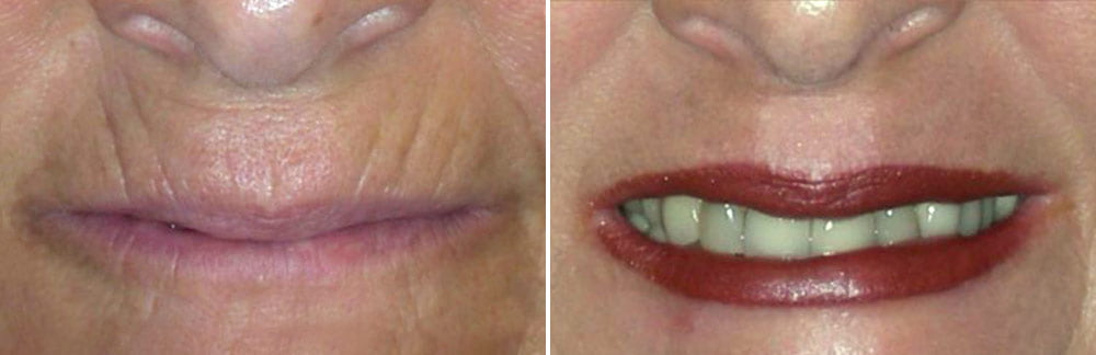 Laser Resurfacing Case # 176