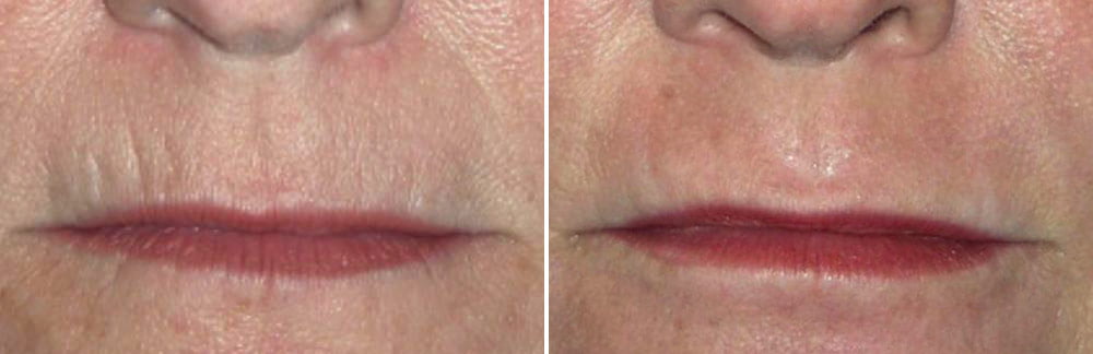 Laser Resurfacing Case # 177