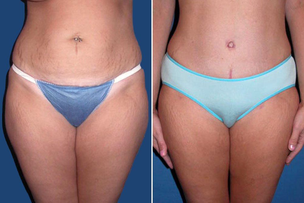 Liposuction Case # 101